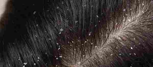 DANDRUFF